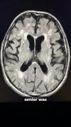 MRI brain scan — early cognitive decline research